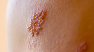 acupuntura na Herpes Zoster