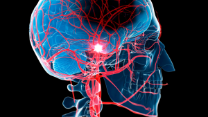 Tratamento do AVC com acupuntura e fitoterapia