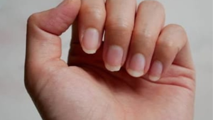 Inspeção das unhas na Medicina Chinesa