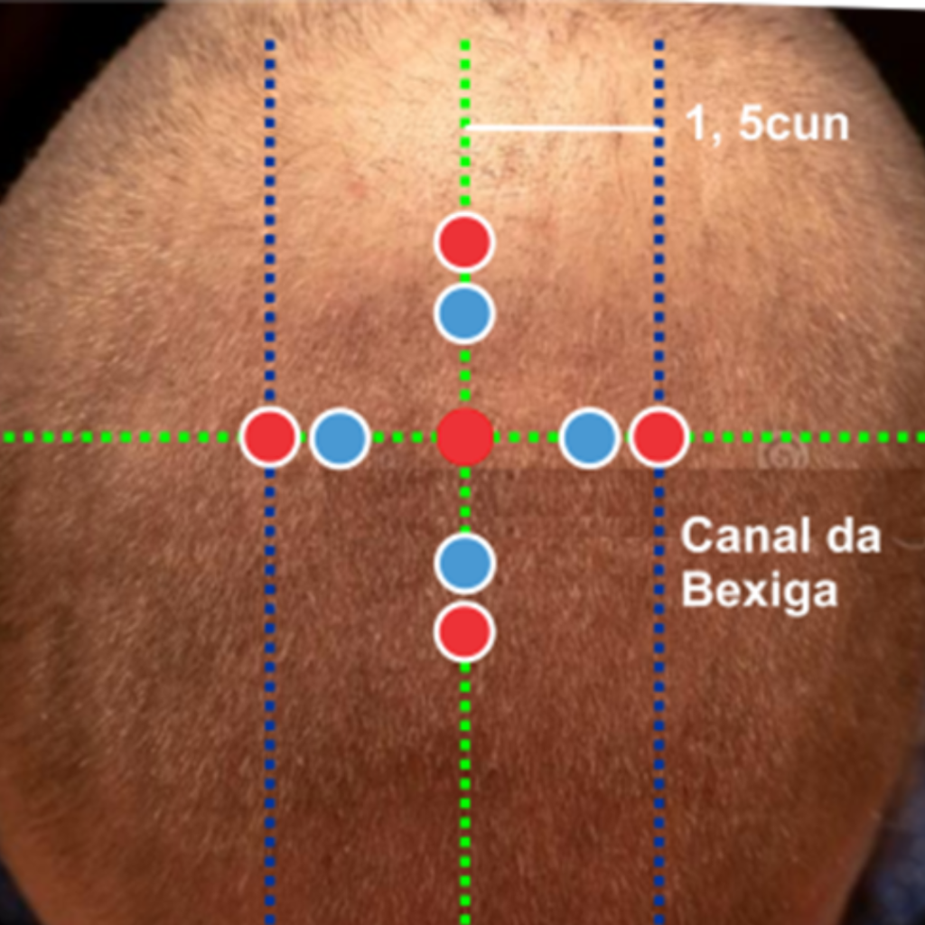 Localização de Si Shen Zhen (4 agulhas da mente) e Si Shen COng (4 cavaleiros) ao redor de VG20 (baihui)