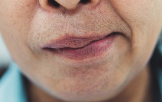 Acupuntura na paralisia de Bell