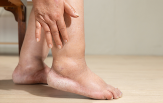 Gota na Medicina Chinesa e associação com marcadores biológicos.