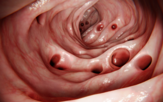 Diverticulite na Medicina Chinesa