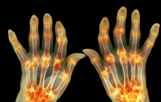 Artrite reumatoide na Medicina Chinesa