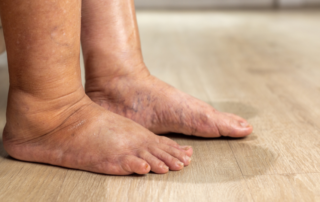 Laser e acupuntura no tratamentode cacifo